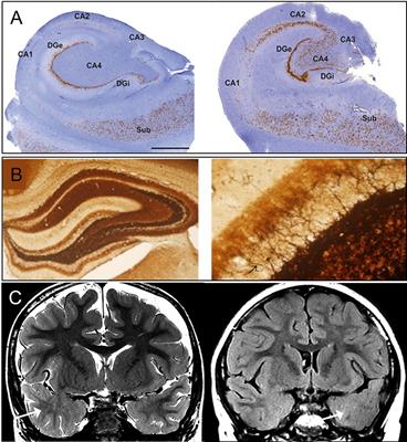 Pathological Targets for Treating Temporal Lobe Epilepsy: Discoveries From Microscale to Macroscale